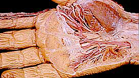 Partial resected right hand showing muscle and vein tissue